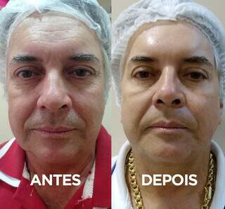 Pacientes que fez o bioestimulador, fios e botox. (Foto: Arquivo pessoal)(Foto: Divulgação)