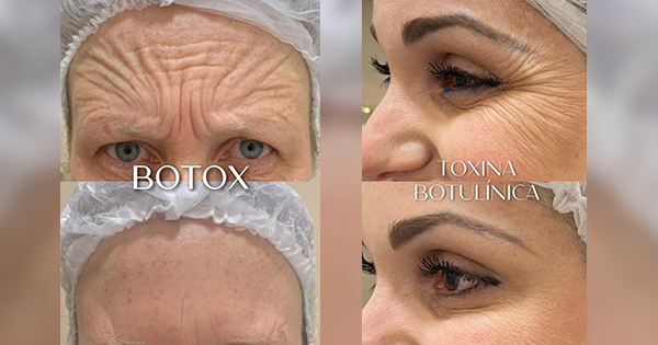 Botox no pescoço: como funciona e quais os benefícios - Royal Face