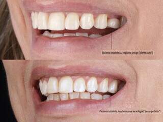 Dente curto foi substituído por implante com novas tecnologias, tornando o sorriso mais bonito. (Foto: Divulgação)