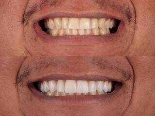 Clareamento de dentes amarelados garante um sorriso mais jovem. (Foto: Divulgação)