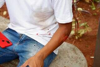 Motociclista de 22 anos ficou com escoriações no braço (Foto: Alex Machado)