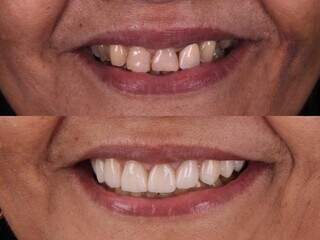 Com o procedimento, os dentes ficam ainda mais naturais. (Foto: Divulgação)
