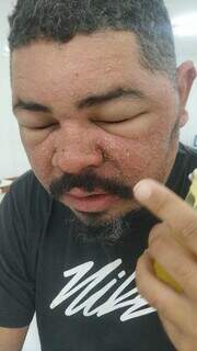Operador de empilhadeira Helton Miranda de Souza mostra sintomas de reação alérgica (Foto: Direto das Ruas)