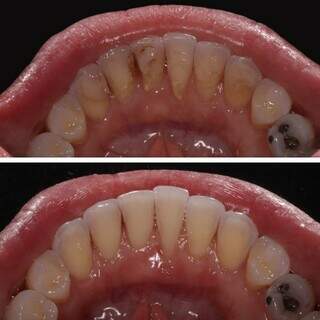 Mudança após o tratamento com dentista faz toda a diferença. (Foto: Divulgação)
