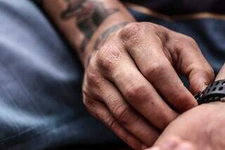 Mãos revelam as marcas de machucados em função da dependência química (Foto: Marcos Maluf)