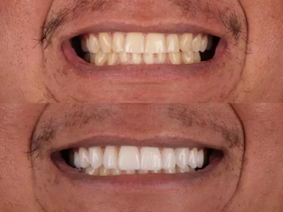 Clareamento de dentes amarelados garante um sorriso mais jovem. (Foto: Divulgação)
