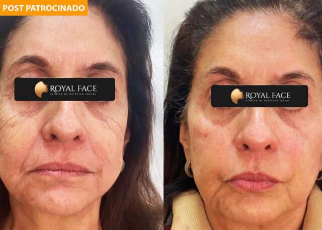 Com 1ª avaliação gratuita, Royal Face é líder em harmonização facial