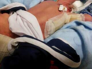 Bebê que sofreu queimaduras ao ser colocado na incubadora do HU de Dourados (Foto: Reprodução)
