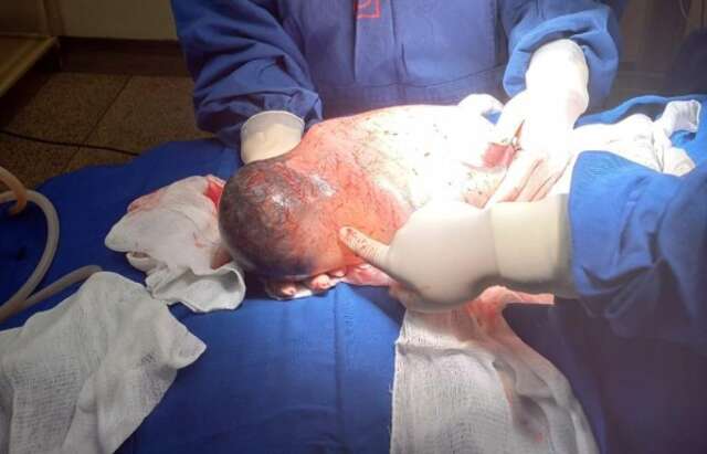 V&iacute;deo: em parto considerado raro, beb&ecirc; nasce empelicado em Costa Rica