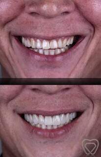 Facetas de resina conseguem deixar a cor dos dentes ideal e &#34;apagar&#34; desgastes. (Foto: Divulgação)