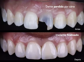 Após dente ser perdido por cárie, sorriso foi retomado com implante. (Foto: Divulgação)