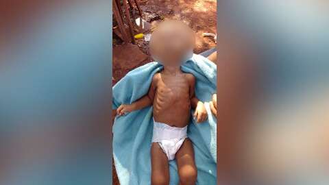 Criança indígena de 1 ano morre vítima de desnutrição em Dourados