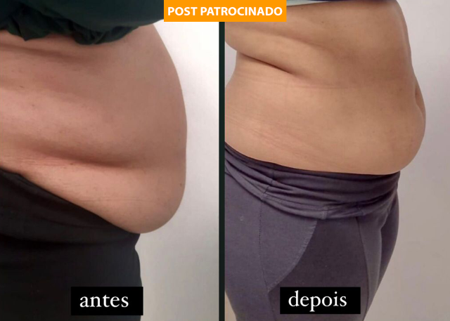 Elimine até 7 centímetros da barriga em uma sessão de crio de placas