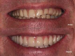 Tratamento para devolver o formato orginal dos dentes melhora a saúde dos pacientes. (Foto: Divulgação)