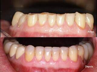 Antes e depois ilustra a transformação com o tratamento dentário. (Foto: Divulgação)