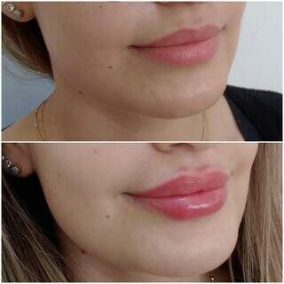 Antes e depois do preenchimento labial (Foto: Divulgação)