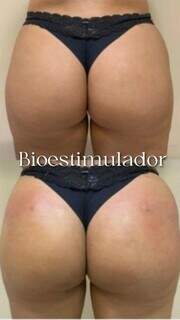 Antes e depois do bioestimulador de colágeno no bumbum (Foto: Divulgação)