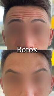 Antes e depois da aplicação de botox (Foto: Divulgação)