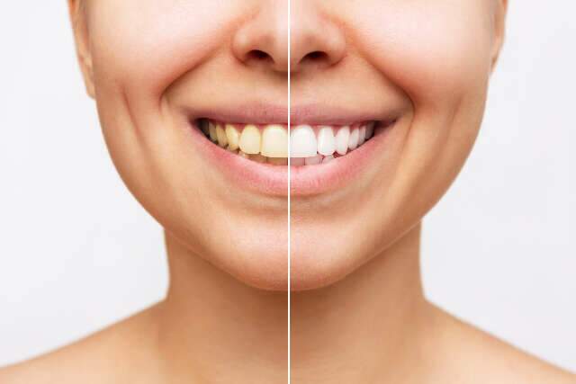 Clareamento deixa os dentes mais fracos?