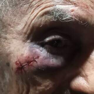 Black eye and stitches that elderly people need after being attacked by their son.  (Photo: Archive)