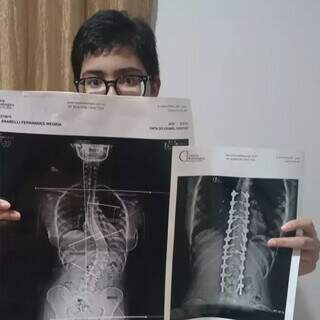 Anabelli segura seu raio X de antes e depois da cirurgia. (Foto: Arquivo Pessoal)