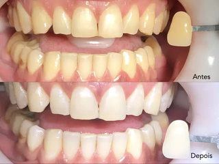 Procedimento de clareamento dental faz toda a diferença para conquistar o sorriso ideal. (Foto: Divulgação)