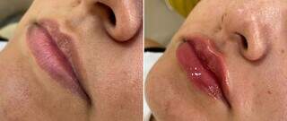 Antes e depois do preenchimento labial e aplicação do Gloss Up. (Foto: Divulgação)