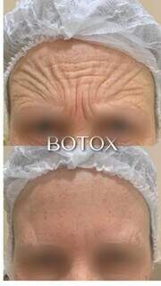 Antes e depois da aplicação de botox na testa. (Foto: Divulgação)
