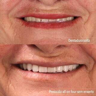 Diferença entre a dentadura solta e protocolo all on four possui diferença visível. (Foto: Divulgação)