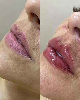 Preenchimento labial hidrata, harmoniza e rejuvenece os lábios. (Foto: Divulgação)