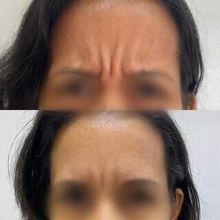 Aplicação de botox resolve marcas de expressão na pele. (Foto: Divulgação)
