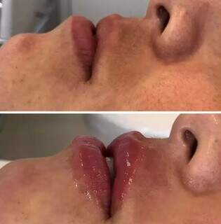 Antes e depois da técnica de preenchimento labial usada por Ana (Foto: Divulgação)
