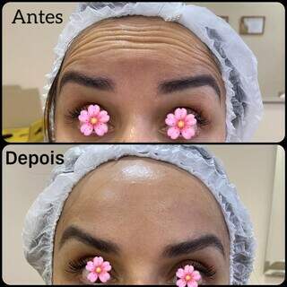 Procedimento queridinho, botox elimina rugas e marcas de expressão na testa. (Foto: Divulgação)