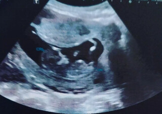 Ultrassom de bebê que teria sido concebido por inseminação caseira (Foto: Reprodução)
