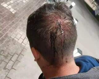 Motorista de aplicativo com a cabeça machucada após ser roubado na madrugada de domingo (10). (Foto: Arquivo pessoal)
