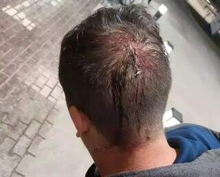 Motorista de aplicativo com a cabeça machucada após ser roubado na madrugada de domingo (Foto: Arquivo pessoal)