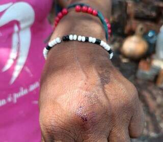Indígena mostra ferimento na mão durante ação da PF em aldeia (Foto: Direto das Ruas)
