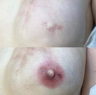 Antes e depois da micropigmentaçao de mamas (Foto: Deise Girardi)
