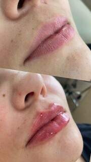 Preenchimento labial traz efeito volumoso que harmoniza com o rosto. (Foto: Divulgação)