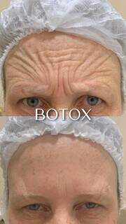Royal Face é referência na aplicação de botox. (Foto: Divulgação)