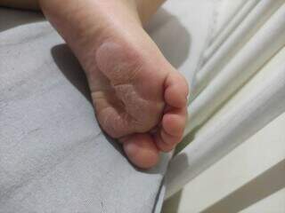 Bolhas no pé do bebê (Foto: Direto das Ruas)