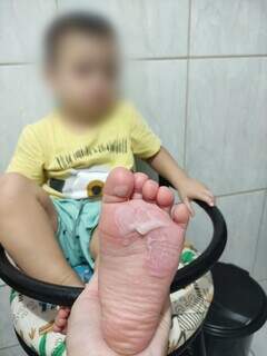 Bebê de um ano e sete meses com o pé queimado (Foto: Direto das Ruas)