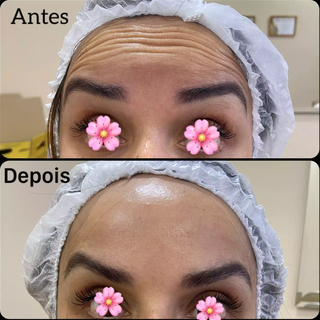 Antes e depois da aplicação de botox. (Foto: Divulgação)