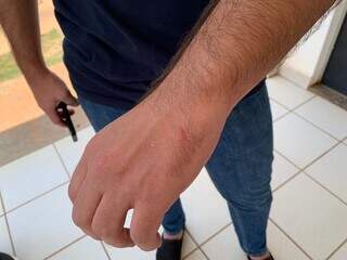 Médico mostra arranhão, fruto da tentativa de agressão feita pelo agente de sáude (Foto: Bruna Marques)