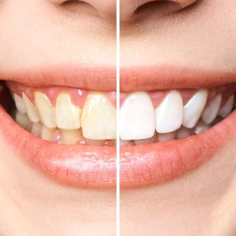 Fazer clareamento deixa os dentes mais fracos?