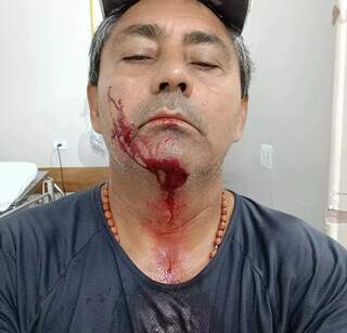 Romeu mostra ferimento que sofreu no rosto (Foto: Cassilândia Notícias)