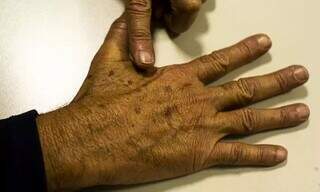 O câncer de pele é uma das formas mais comuns da doença no Brasil (Foto: Agência Brasil)