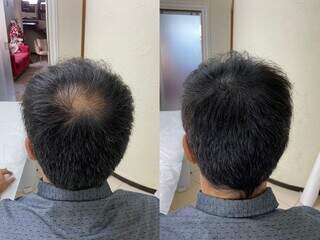 Já a Micropigmentação Capilar, conhecida como tatuagem capilar, é indicada para pessoas que sofrem de alopecia em áreas específicas do couro cabeludo.