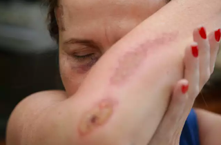 Mulher mostra os hematomas sofridos durante violência doméstica  (Foto: arquivo / Campo Grande News) 