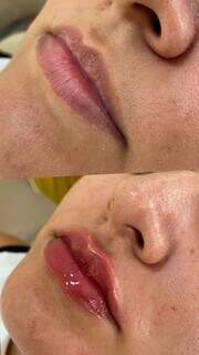 No verão da Royal Face preenchimento labial está com preço especial. (Foto: Divulgação)
